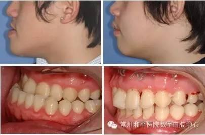 上扁头成人怎么矫正视频,视频教程助你重塑完美头型