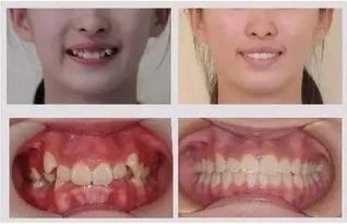 上扁头成人怎么矫正视频,视频教程助你重塑完美头型